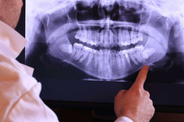 Best Emergency Wisdom Teeth Removal in Flowood, MS