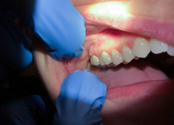 Best Emergency Wisdom Teeth Removal in Flowood, MS